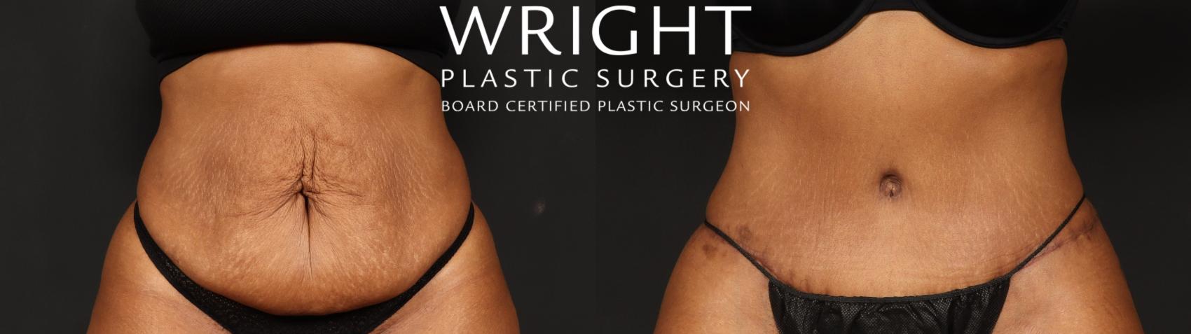 Before & After Tummy Tuck Case 654 Front View in Little Rock, Arkansas