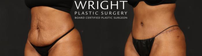 Before & After Tummy Tuck Case 654 Left Oblique View in Little Rock, Arkansas