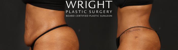 Before & After Tummy Tuck Case 654 Left Side View in Little Rock, Arkansas