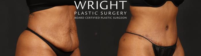 Before & After Tummy Tuck Case 654 Right Oblique View in Little Rock, Arkansas