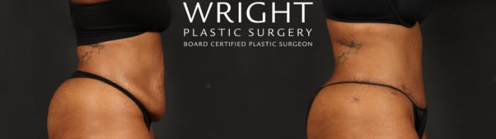 Before & After Tummy Tuck Case 654 Right Side View in Little Rock, Arkansas