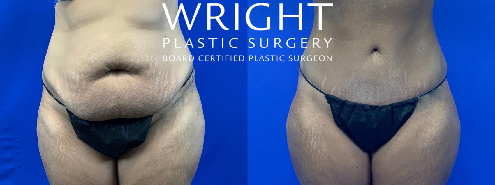 Adominoplasty (Tummy Tuck) & Liposuction - Case #02402 - The Plastic  Surgery Group