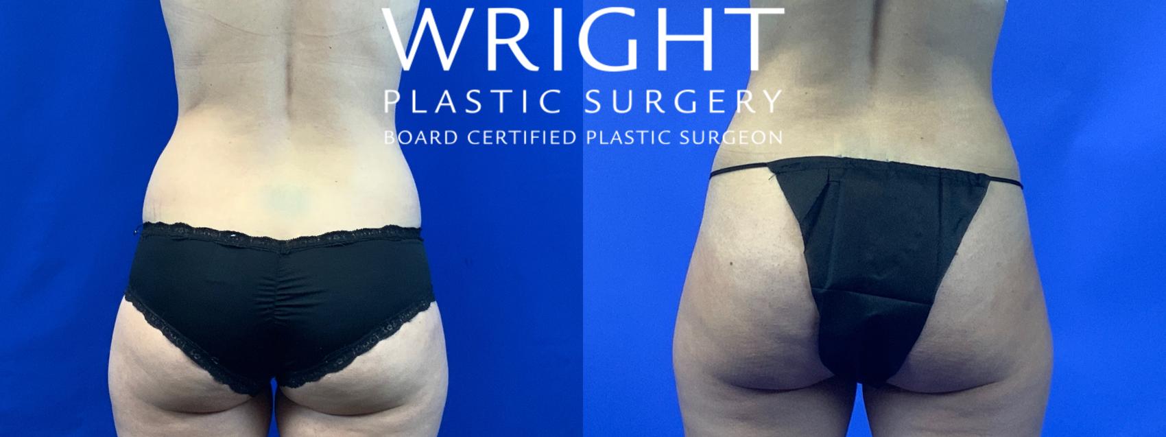 Before & After Tummy Tuck Case 68 Back View in Little Rock, Arkansas