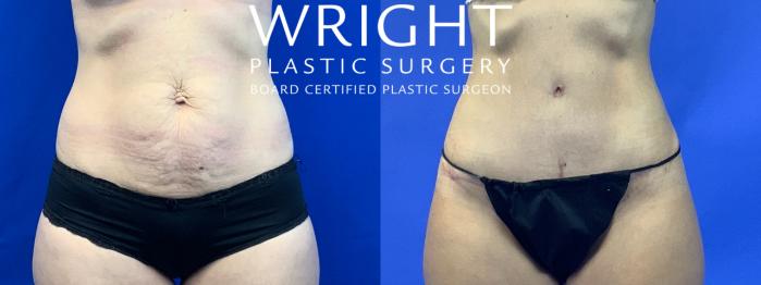 Before & After Tummy Tuck Case 68 Front View in Little Rock, Arkansas