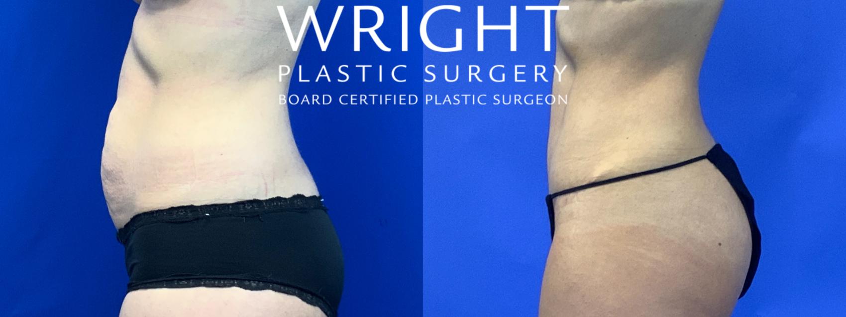 Before & After Tummy Tuck Case 68 Left Side View in Little Rock, Arkansas