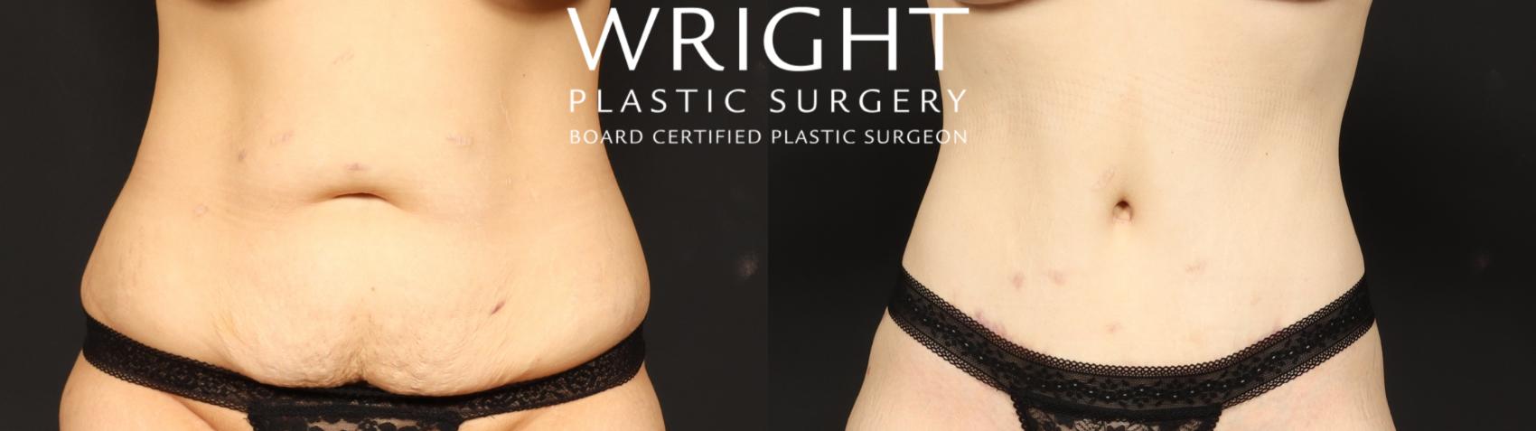 Before & After Tummy Tuck Case 685 Front View in Little Rock, Arkansas