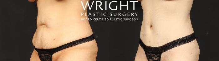 Before & After Tummy Tuck Case 685 Left Oblique View in Little Rock, Arkansas