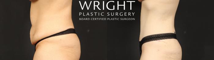 Before & After Tummy Tuck Case 685 Left Side View in Little Rock, Arkansas