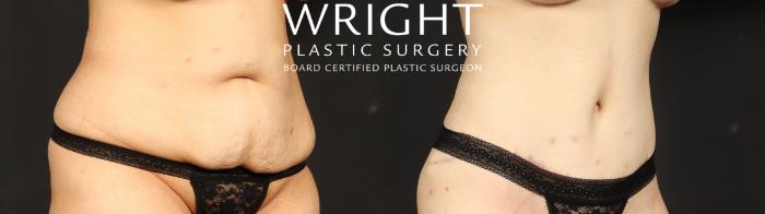 Before & After Tummy Tuck Case 685 Right Oblique View in Little Rock, Arkansas