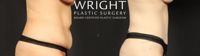 Before & After Tummy Tuck Case 685 Right Side View in Little Rock, Arkansas