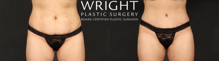 Before & After Tummy Tuck Case 686 Front View in Little Rock, Arkansas