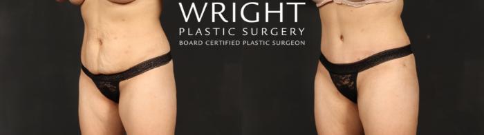 Before & After Tummy Tuck Case 686 Left Oblique View in Little Rock, Arkansas