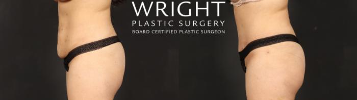 Before & After Tummy Tuck Case 686 Left Side View in Little Rock, Arkansas