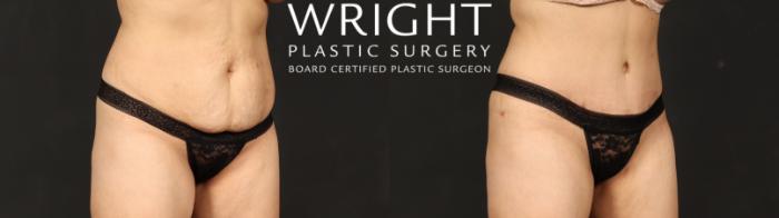 Before & After Tummy Tuck Case 686 Right Oblique View in Little Rock, Arkansas