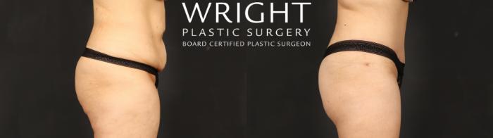 Before & After Tummy Tuck Case 686 Right Side View in Little Rock, Arkansas