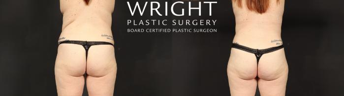Before & After Tummy Tuck Case 687 Back View in Little Rock, Arkansas