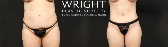 Before & After Tummy Tuck Case 687 Front View in Little Rock, Arkansas