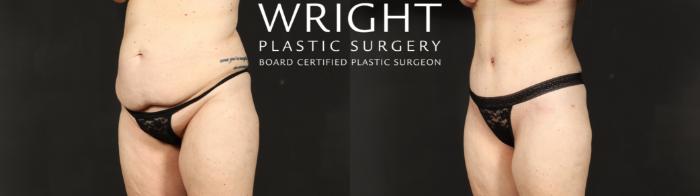 Before & After Tummy Tuck Case 687 Left Oblique View in Little Rock, Arkansas