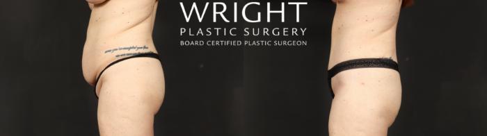 Before & After Tummy Tuck Case 687 Left Side View in Little Rock, Arkansas