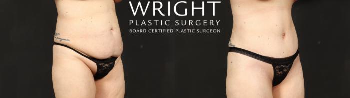 Before & After Tummy Tuck Case 687 Right Oblique View in Little Rock, Arkansas
