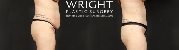 Before & After Tummy Tuck Case 687 Right Side View in Little Rock, Arkansas