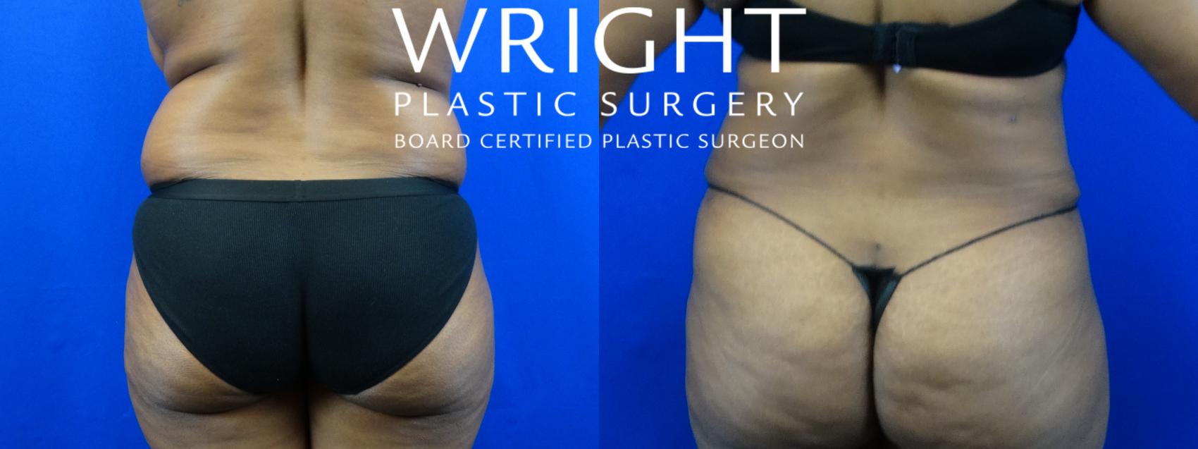 Before & After Tummy Tuck Case 7 Back View in Little Rock, Arkansas