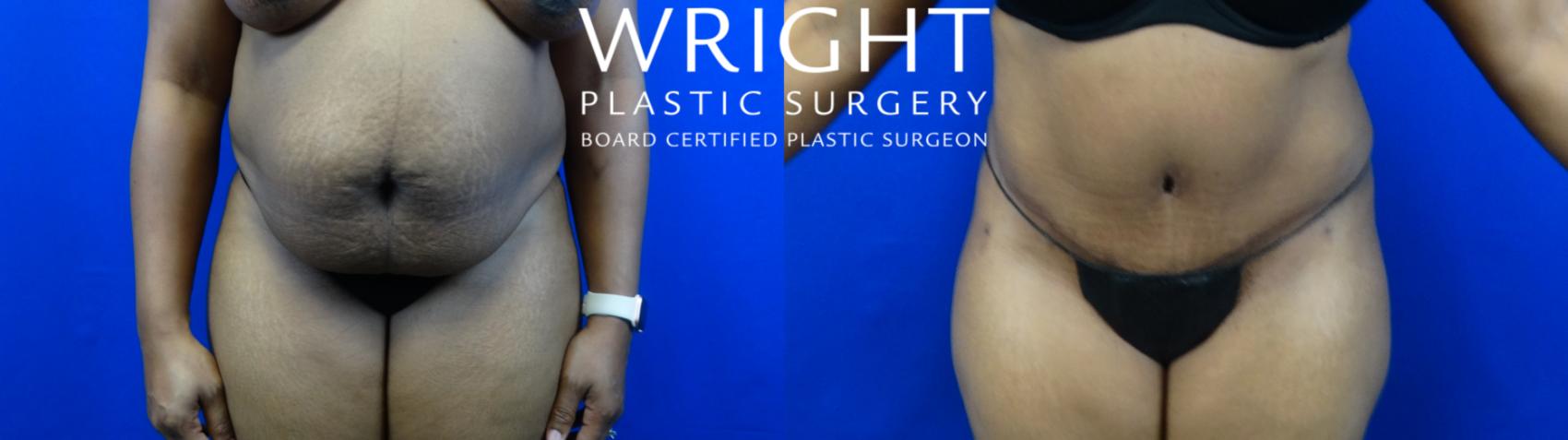 Before & After Tummy Tuck Case 7 Front View in Little Rock, Arkansas