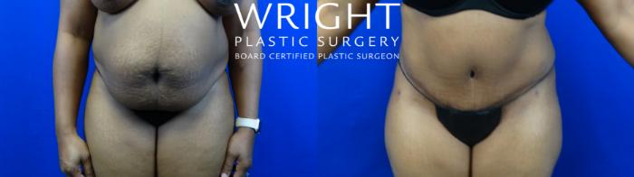 Before & After Liposuction Case 7 Front View in Little Rock, Arkansas