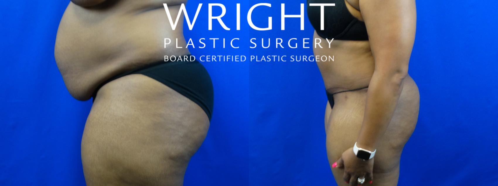 Before & After Tummy Tuck Case 7 Left Side View in Little Rock, Arkansas