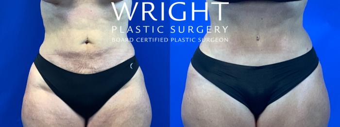 Before & After Tummy Tuck Case 85 Front View in Little Rock, Arkansas