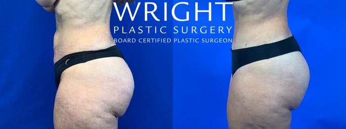 Before & After Tummy Tuck Case 85 Left Side View in Little Rock, Arkansas