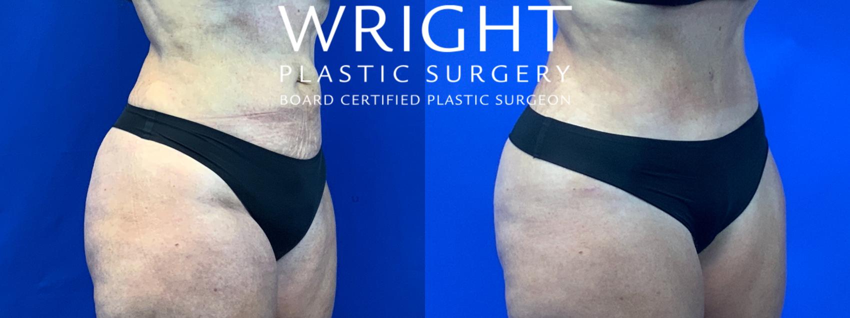 Before & After Tummy Tuck Case 85 Right Oblique View in Little Rock, Arkansas