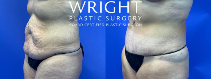 Before & After Tummy Tuck Case 89 Left Oblique View in Little Rock, Arkansas